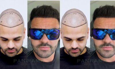 Hair Transplant Center