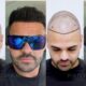 Hair Transplant Center