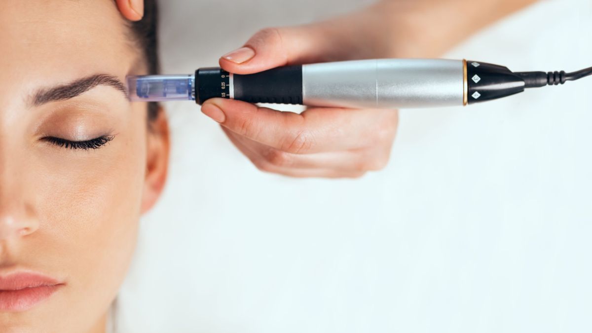 Microneedling